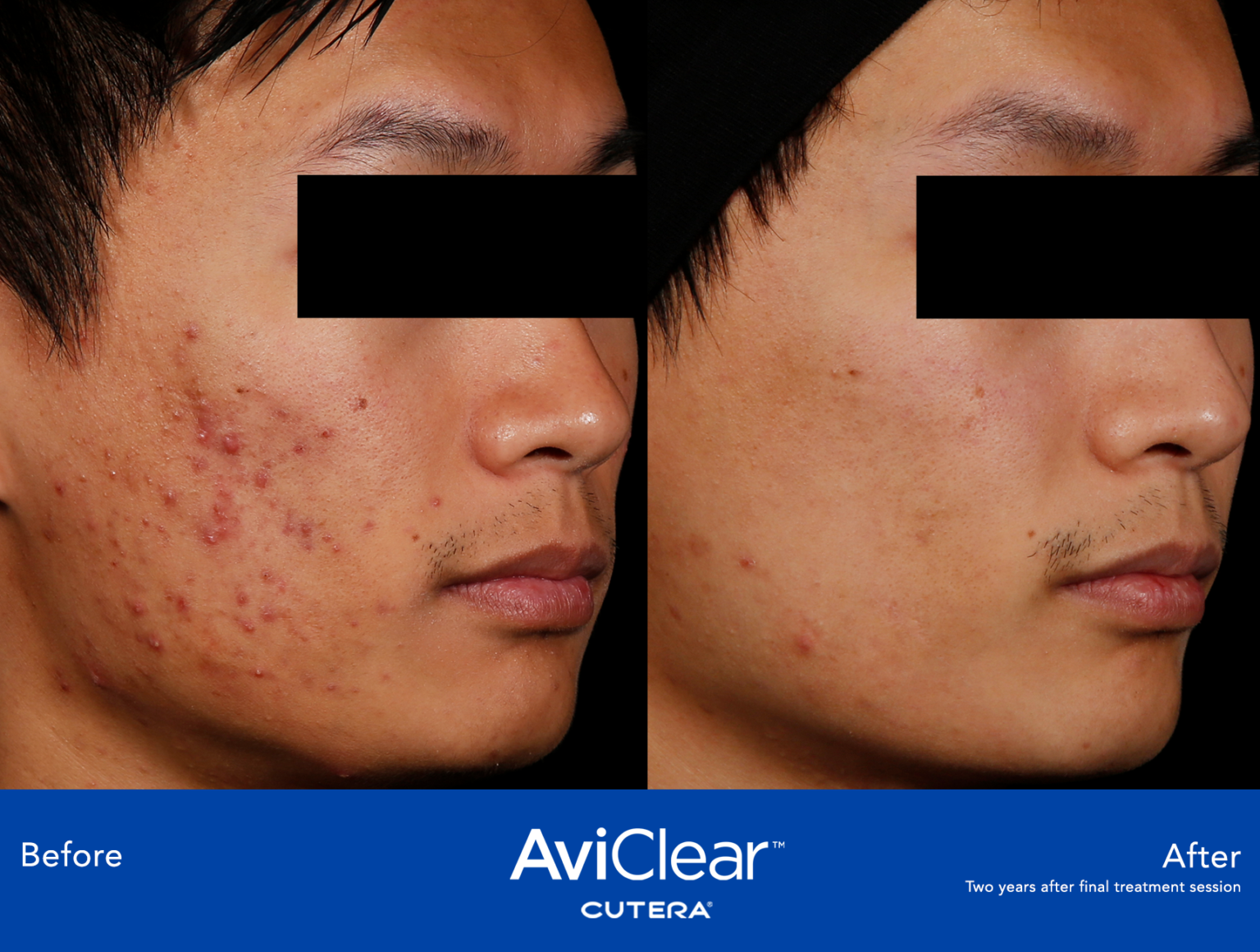 AviClear®: Acne Laser Treatment - Best Acne Treatment Boston