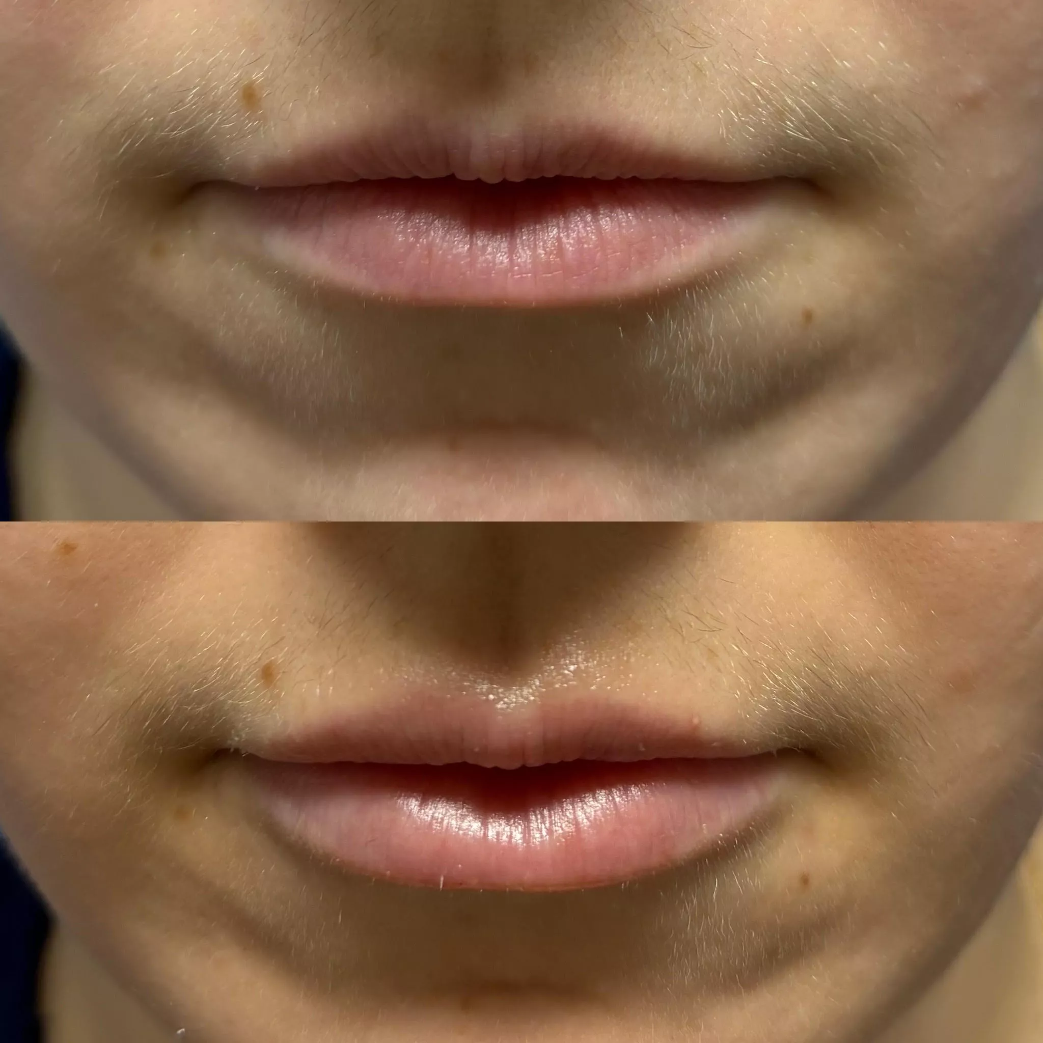 Before and after image of lip filler treatment showcasing increased lip volume and enhanced lip definition, demonstrating real results from a real patient.